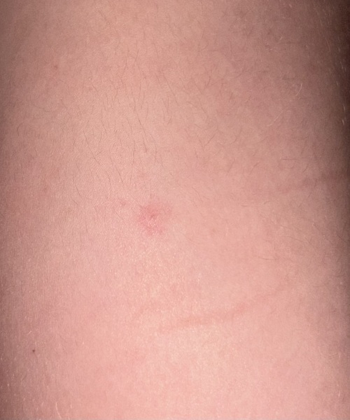 Does this look like chicken pox? Also I’m pregnant so need advice if so!