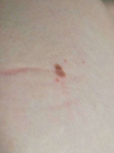 Should I have this Mole checked?