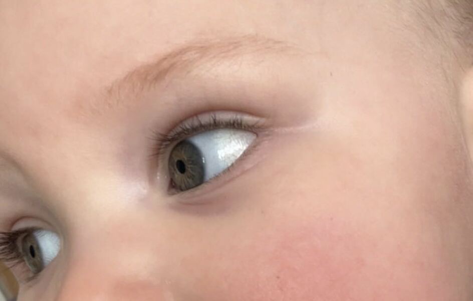 Connective tissue disorder