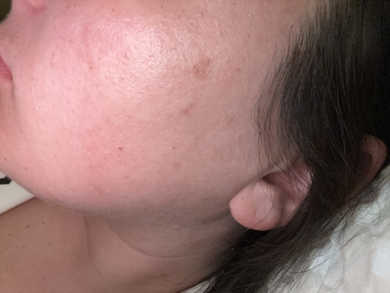 Hyperpigmentation?