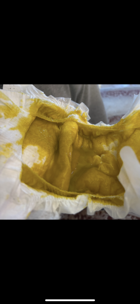 EBF nappy or allergy? Poo pics