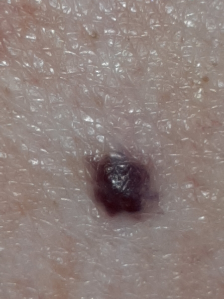 Moles - suspicious?