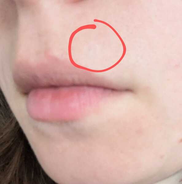 Mole removal (ultra high frequency em)