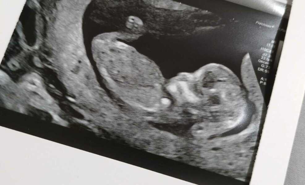 Gender guess from 12 week scan?