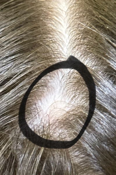 Do you this is Alopecia areata