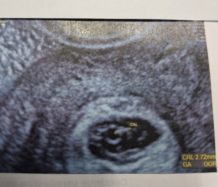 6.5 week scan with a very small embryo