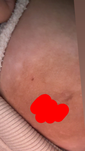 Black spot/ mole on my nipples, help! Pregnant