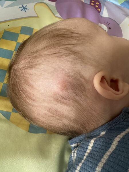 Raised lump on babies scalp