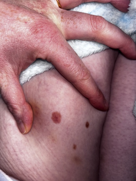 Itchy big mole.. HELP!