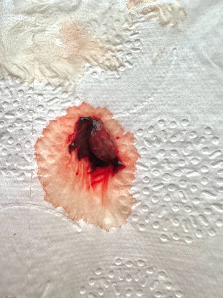 Is this miscarriage tissue - TW graphic photo