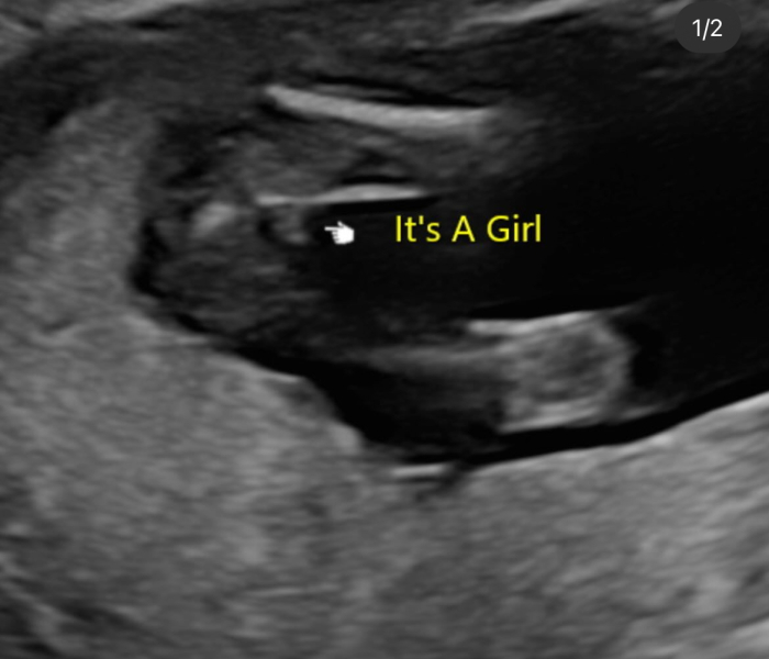 20 week potty shot - boy or girl?
