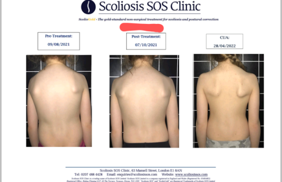 Is this scoliosis ? DD 17