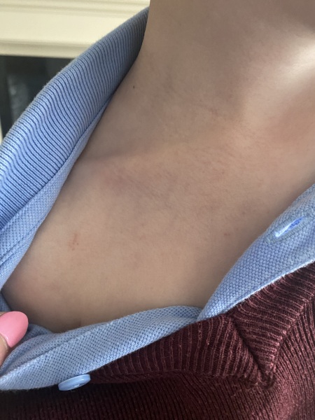 Rash