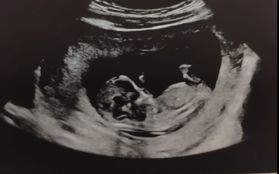 Has anyone been told the gender at 12 week scan?