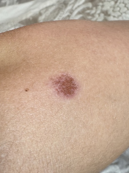 Round raw patch of skin on arm- what is this?
