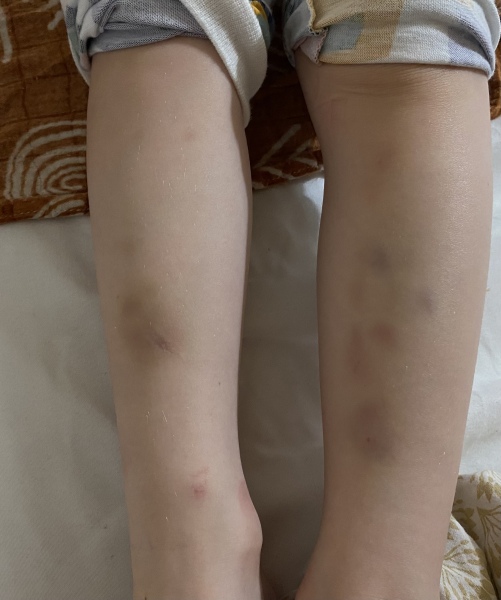 Would you worry about these bruises? 3.5yr old