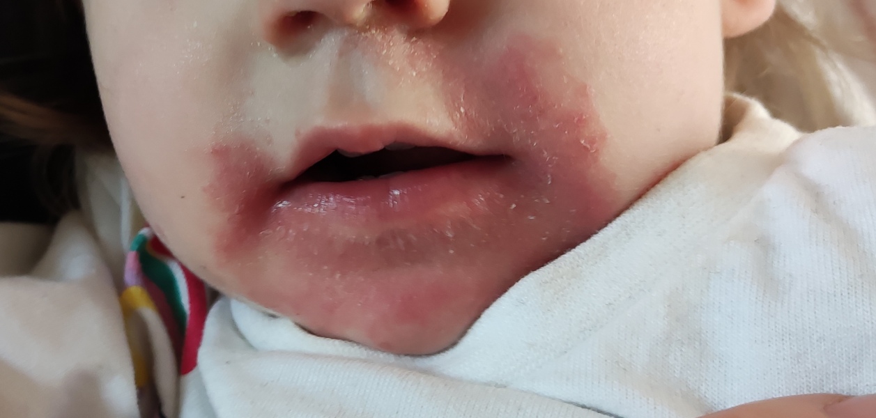 Toddler rash help. Desperate mum here