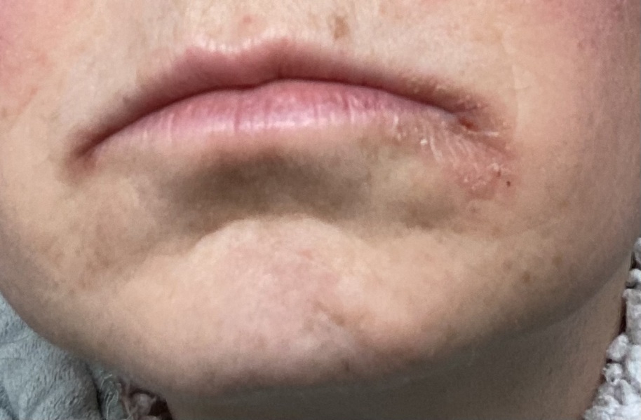 Sore lips (pic attached)