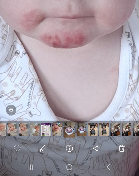 1yo due an allergy test