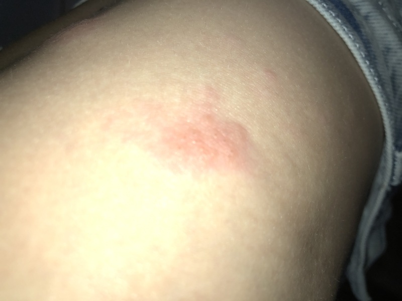 14yo has very bad rashes/bumps