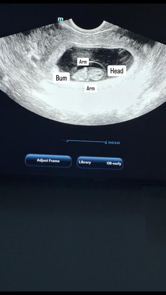 9 weeks ultrasound