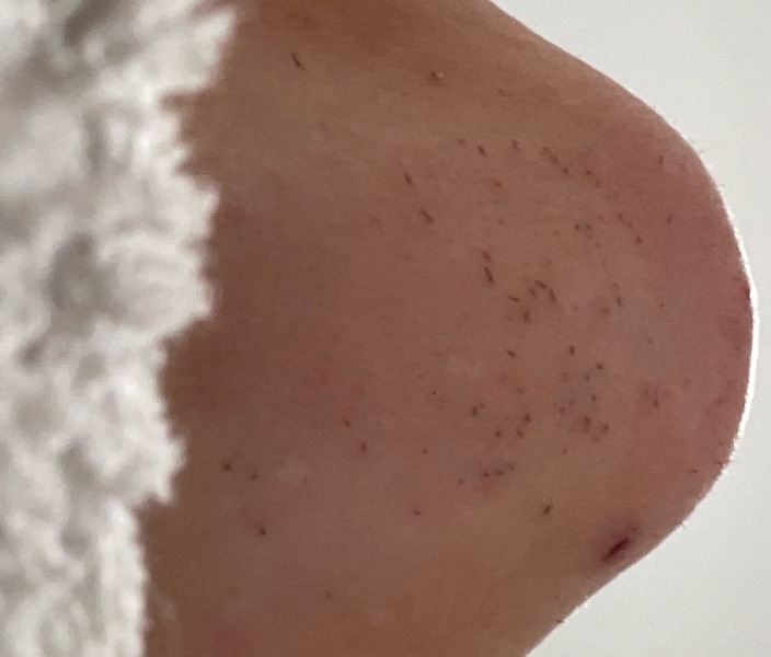 Philips Lumea questions, including which model