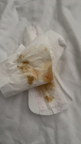 TMI PHOTO MUCUS PLUG