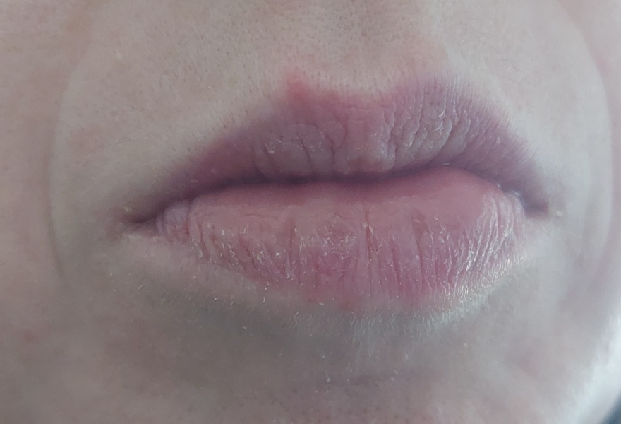 Is this a coldsore - I kissed my baby and am very worried