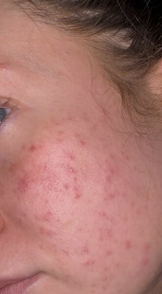 Breakouts at 30.. help 😭