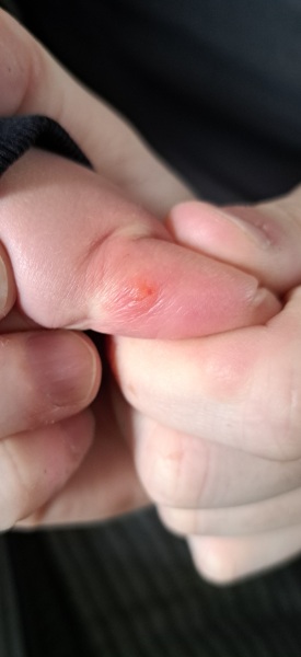 Blister ?? What is it ?