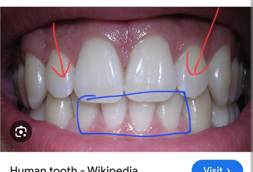 What braces as an adult?