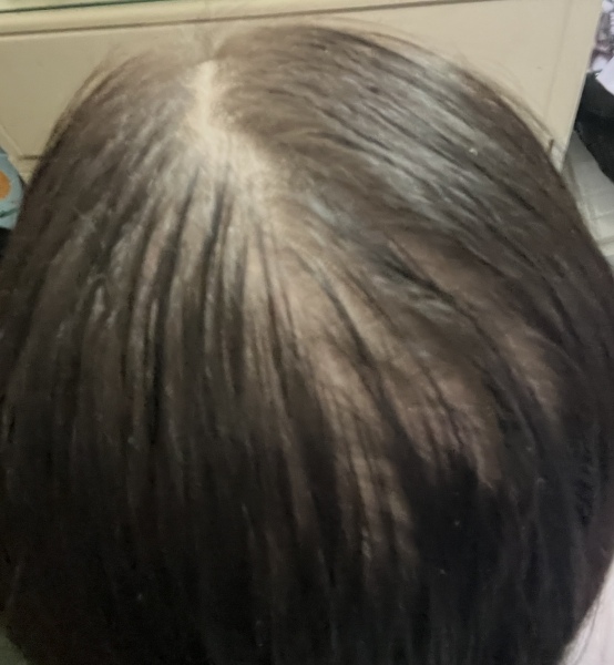 Am I balding