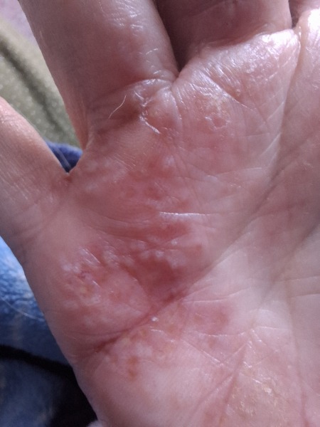 Hand infected (Warning, gross photos)