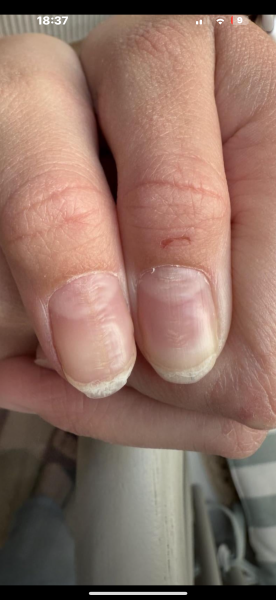 Beaus nails? Could it be zinc deficiency