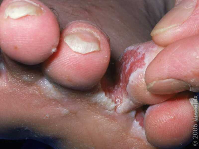 Is this athletes foot ?