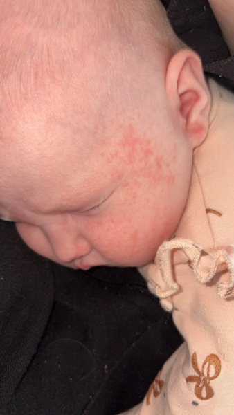 Baby rash