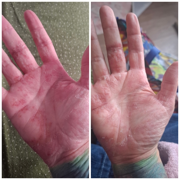 Can anyone help with my eczema? Horrible pics attached!