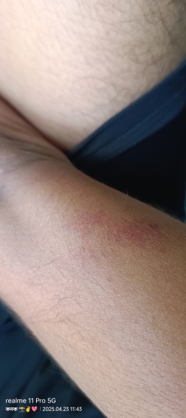 To present to ED with 13yr old rash.