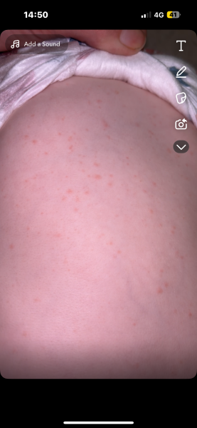 rash