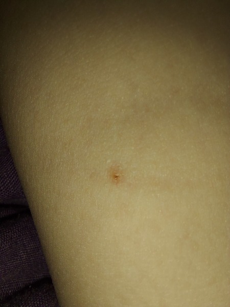 Is this scabies or something else?