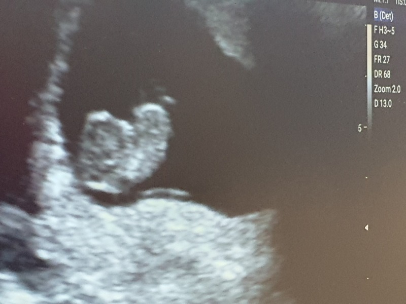 9 weeks ultrasound
