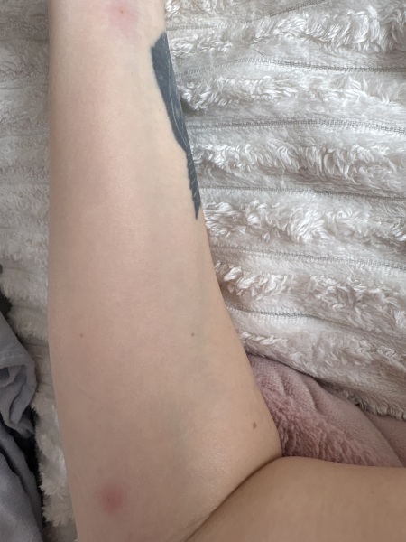 Lumps