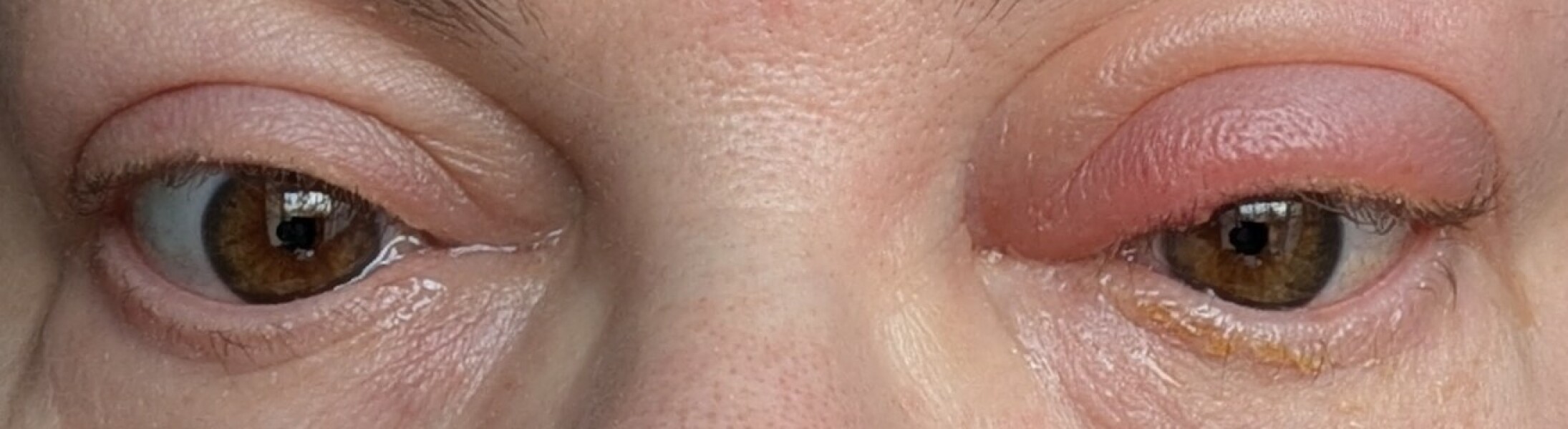 Best home treatment for blepharitis