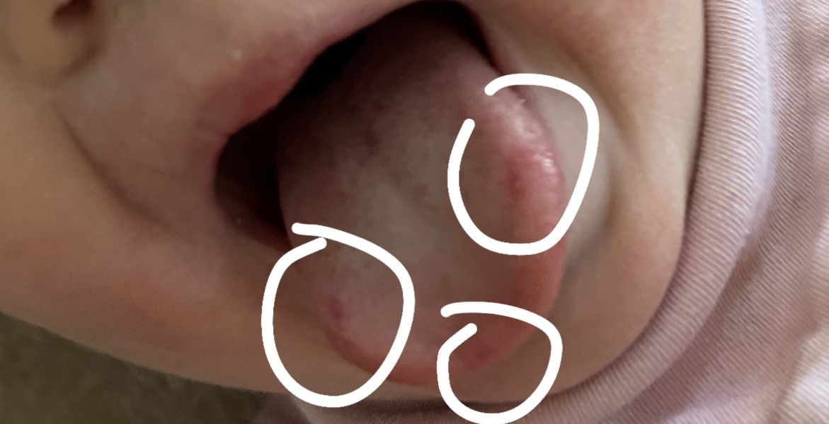 Mouth ulcers - allergies ? Illness? 18mo