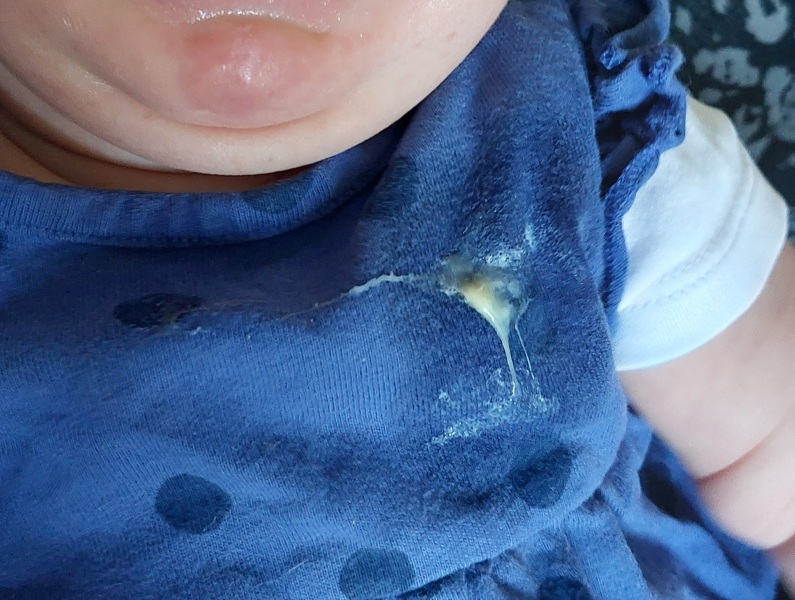 Snot/mucus in 11 week old baby spit up - should I be worried? *pic included