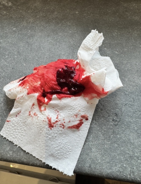 Trigger warning - photo. Possible miscarriage?