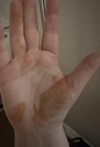 What’s this orangey/brown staining on hand