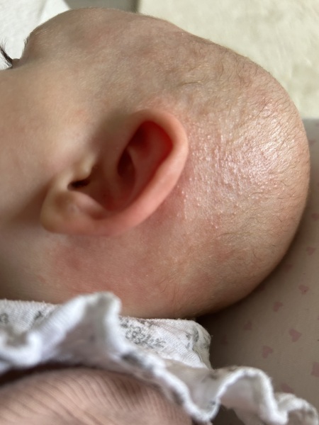 Eczema? 4 month old