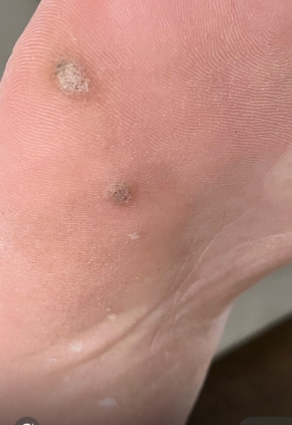 Warning - foot picture! What’s wrong with my OH’s foot?