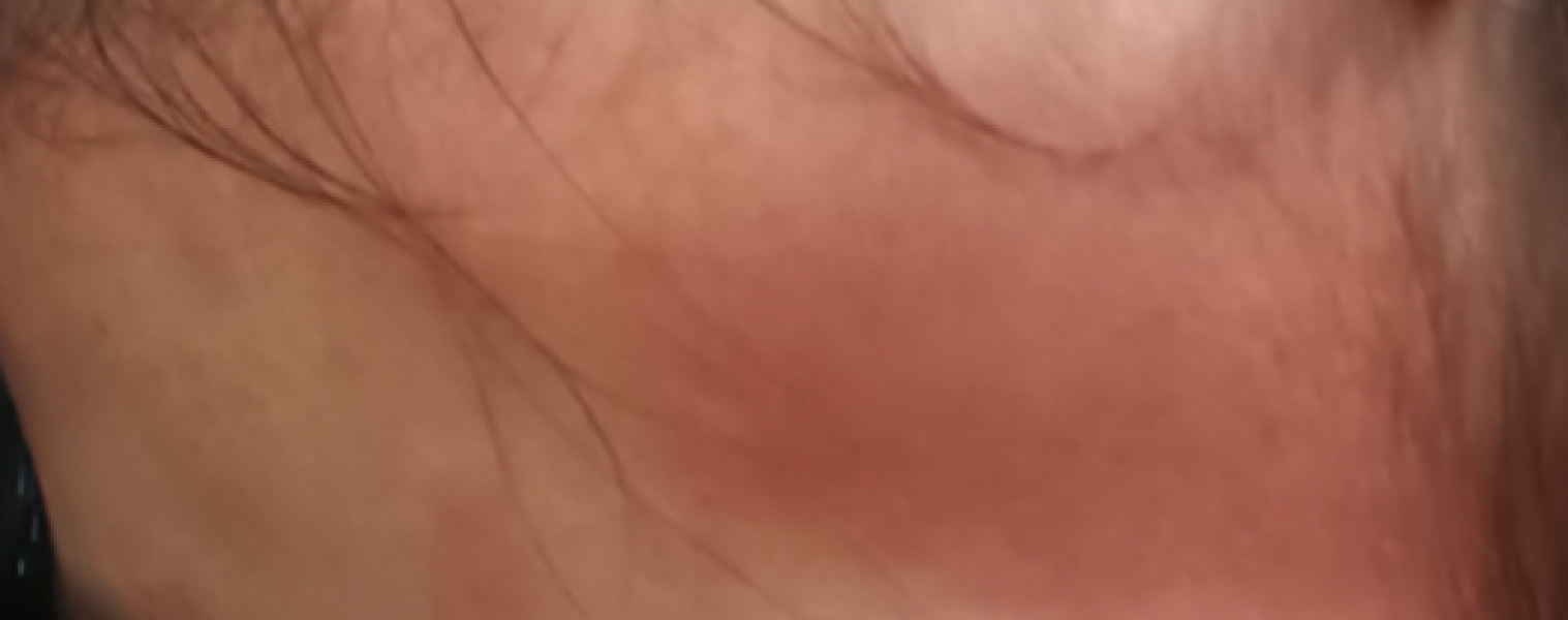 Contact dermatitis / eczema